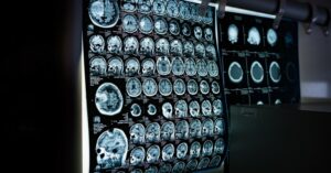 Read more about the article AI nearly twice as good as biopsy at assessing rare cancer
<span class="bsf-rt-reading-time"><span class="bsf-rt-display-label" prefix=""></span> <span class="bsf-rt-display-time" reading_time="1"></span> <span class="bsf-rt-display-postfix" postfix="min read"></span></span><!-- .bsf-rt-reading-time -->
